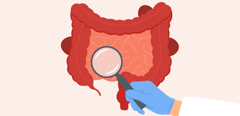 Colorectal Cancer (Colon Cancer)